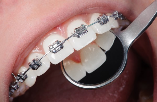 cleaning-teeth-with-braces